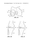 Patient Selectable Knee Arthroplasty Devices diagram and image