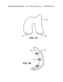 Patient Selectable Knee Arthroplasty Devices diagram and image