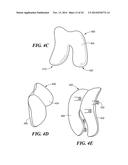 Patient Selectable Knee Arthroplasty Devices diagram and image