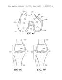 Patient Selectable Knee Arthroplasty Devices diagram and image