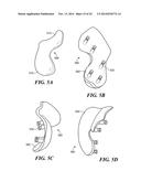 Patient Selectable Knee Arthroplasty Devices diagram and image