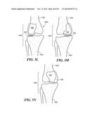 Patient Selectable Knee Arthroplasty Devices diagram and image