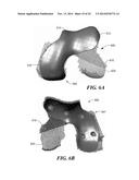 Patient Selectable Knee Arthroplasty Devices diagram and image