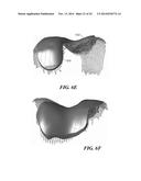 Patient Selectable Knee Arthroplasty Devices diagram and image