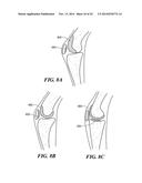 Patient Selectable Knee Arthroplasty Devices diagram and image