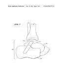 ANKLE REPLACEMENT SYSTEM diagram and image