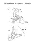 ANKLE REPLACEMENT SYSTEM diagram and image