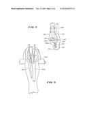 ANKLE REPLACEMENT SYSTEM diagram and image