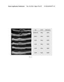 TREATMENT OF AMD USING AAV SFLT-1 diagram and image