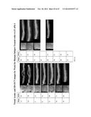 TREATMENT OF AMD USING AAV SFLT-1 diagram and image