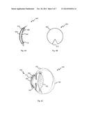 NON-INVASIVE REFRACTIVE TREATMENT USING NANOPARTICLES diagram and image