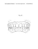 POSITIONING JIG AND IMPROVED METHODS TO DESIGN AND MANUFACTURE DENTAL     IMPLANTS diagram and image