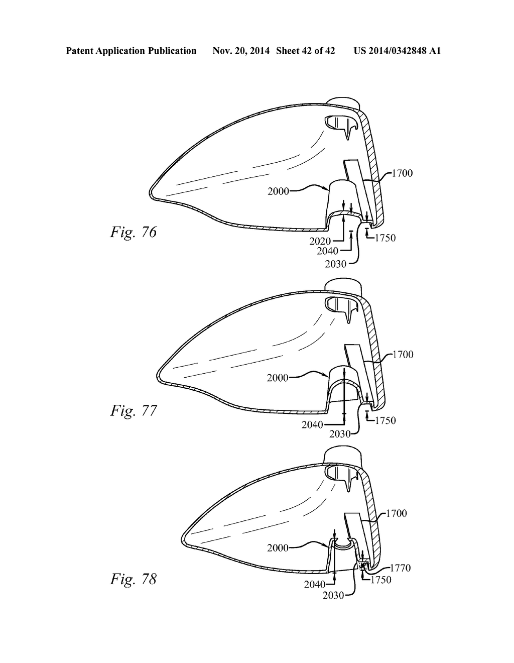 GOLF CLUB HEAD HAVING A STRESS REDUCING FEATURE - diagram, schematic, and image 43