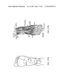 Methods, Systems, and Devices for Treating Neuromas, Fibromas, Nerve     Entrapment, and/or Pain Associated Therewith diagram and image