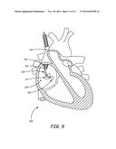 SYSTEM AND METHOD FOR POSITIONING IMPLANTABLE MEDICAL DEVICES WITHIN     CORONARY VEINS diagram and image