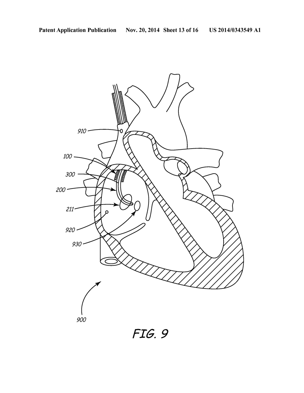 SYSTEM AND METHOD FOR POSITIONING IMPLANTABLE MEDICAL DEVICES WITHIN     CORONARY VEINS - diagram, schematic, and image 14