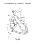 SYSTEM AND METHOD FOR POSITIONING IMPLANTABLE MEDICAL DEVICES WITHIN     CORONARY VEINS diagram and image