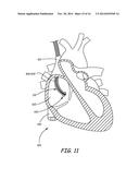 SYSTEM AND METHOD FOR POSITIONING IMPLANTABLE MEDICAL DEVICES WITHIN     CORONARY VEINS diagram and image