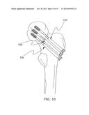 BONE SCREW SYSTEM AND METHOD diagram and image