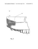 COMPUTER-IMPLEMENTED TECHNIQUE FOR DEFINING A BONE CUT diagram and image