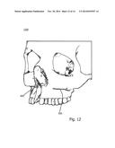 COMPUTER-IMPLEMENTED TECHNIQUE FOR DEFINING A BONE CUT diagram and image