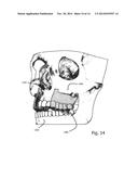 COMPUTER-IMPLEMENTED TECHNIQUE FOR DEFINING A BONE CUT diagram and image