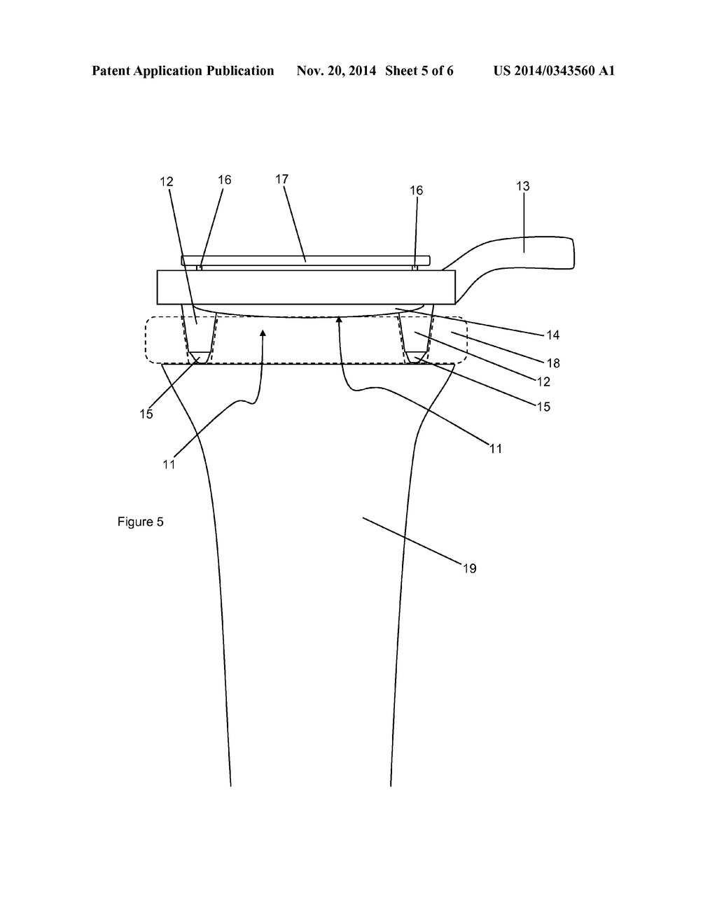 DEVICE AND METHOD FOR THE IN-SITU PRODUCTION OF ARTICULATED SPACERS - diagram, schematic, and image 06