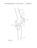 FEMORAL SIZING INSTRUMENT diagram and image