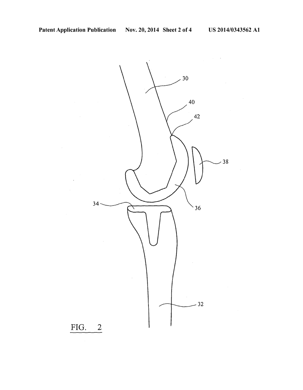 FEMORAL SIZING INSTRUMENT - diagram, schematic, and image 03