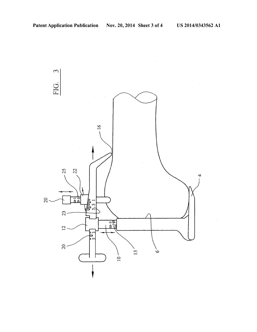 FEMORAL SIZING INSTRUMENT - diagram, schematic, and image 04