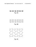 Device, And A Method For Treatment Of Increased Blood Pressure diagram and image