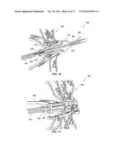 MEDICAL DEVICE FOR MODIFICATION OF LEFT ATRIAL APPENDAGE AND RELATED     SYSTEMS AND METHODS diagram and image