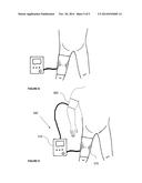 MULTI-MODE INFLATABLE LIMB OCCLUSION DEVICE diagram and image