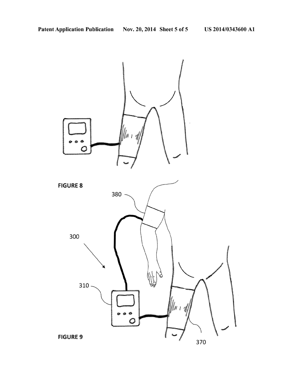MULTI-MODE INFLATABLE LIMB OCCLUSION DEVICE - diagram, schematic, and image 06
