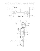 CLIP-BASED SYSTEMS AND METHODS FOR TREATING SEPTAL DEFECTS diagram and image