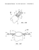 CLIP-BASED SYSTEMS AND METHODS FOR TREATING SEPTAL DEFECTS diagram and image