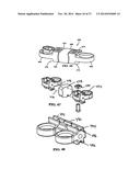 Flexible Spine Stabilization System diagram and image