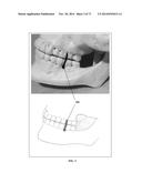 DENTAL OCCLUSION AND TENSION BAND TIES, SYSTEMS AND METHODS diagram and image