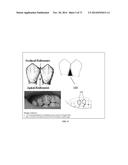 DENTAL OCCLUSION AND TENSION BAND TIES, SYSTEMS AND METHODS diagram and image