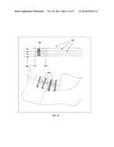 DENTAL OCCLUSION AND TENSION BAND TIES, SYSTEMS AND METHODS diagram and image