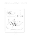 DENTAL OCCLUSION AND TENSION BAND TIES, SYSTEMS AND METHODS diagram and image