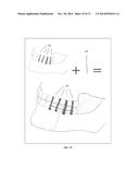 DENTAL OCCLUSION AND TENSION BAND TIES, SYSTEMS AND METHODS diagram and image