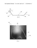 DENTAL OCCLUSION AND TENSION BAND TIES, SYSTEMS AND METHODS diagram and image