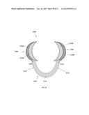 DENTAL OCCLUSION AND TENSION BAND TIES, SYSTEMS AND METHODS diagram and image