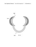 DENTAL OCCLUSION AND TENSION BAND TIES, SYSTEMS AND METHODS diagram and image