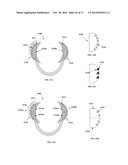 DENTAL OCCLUSION AND TENSION BAND TIES, SYSTEMS AND METHODS diagram and image