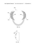 DENTAL OCCLUSION AND TENSION BAND TIES, SYSTEMS AND METHODS diagram and image