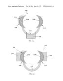 DENTAL OCCLUSION AND TENSION BAND TIES, SYSTEMS AND METHODS diagram and image