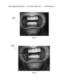 DENTAL OCCLUSION AND TENSION BAND TIES, SYSTEMS AND METHODS diagram and image