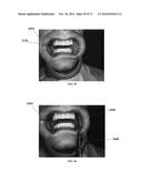 DENTAL OCCLUSION AND TENSION BAND TIES, SYSTEMS AND METHODS diagram and image